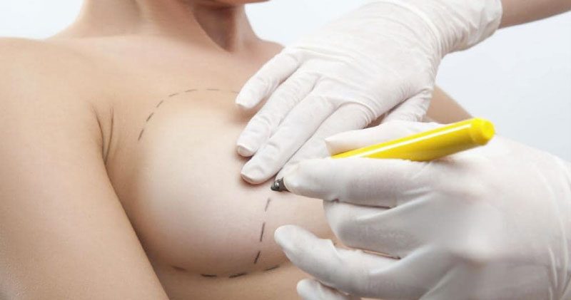 chirurgia al seno